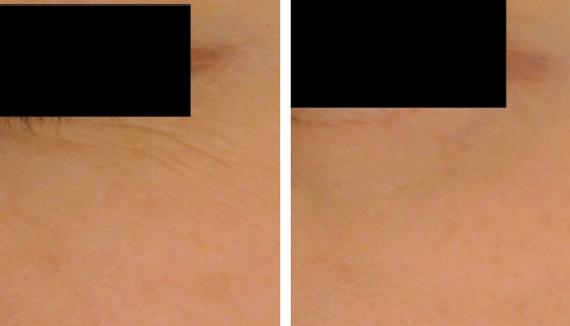 Forlle'd Befoer & After