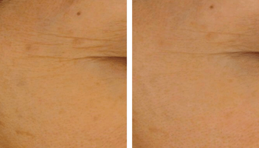 Forlle'd Before & After