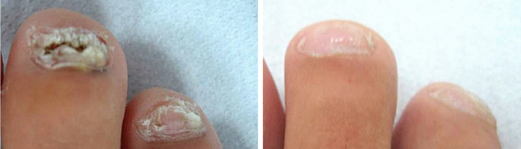 Nail Fungus #2