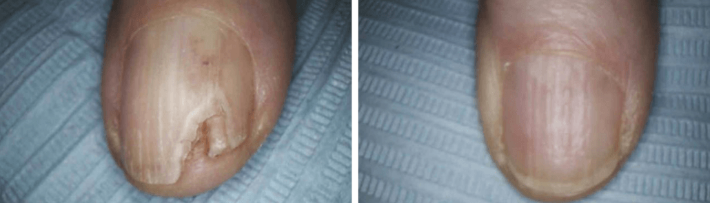 Nail Fungus #3