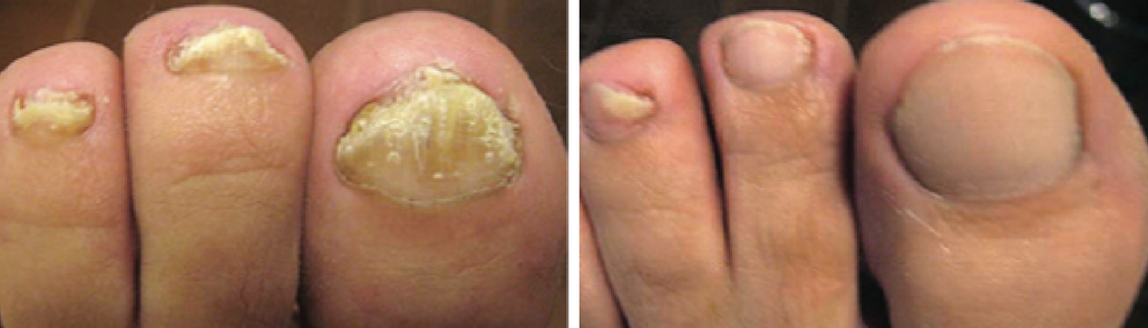 Nail Fungus