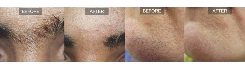 VMS Hair Removal Feature Image