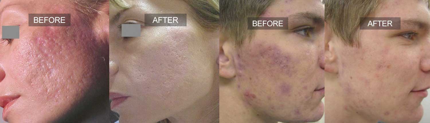 Active Acne Treatment Feature Image