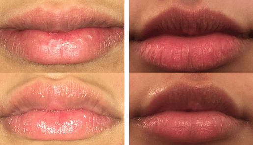 Laser Lip Remodelling