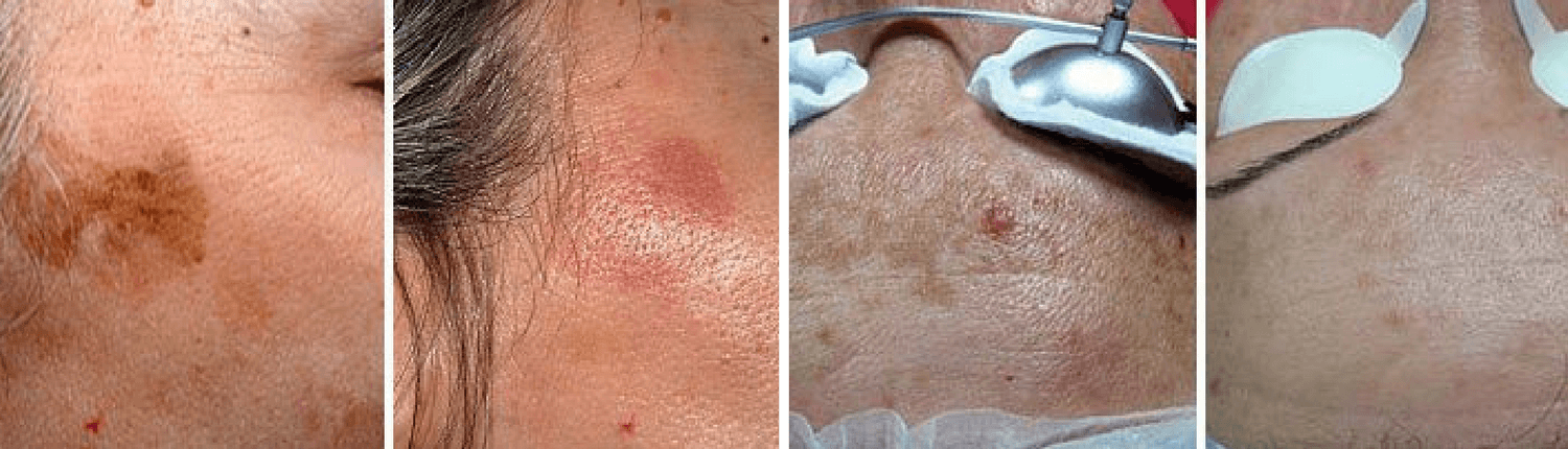 pigmented lesions