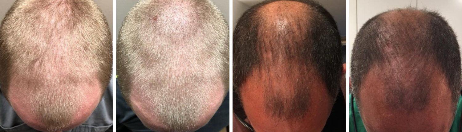 Laser Hair Restoration
