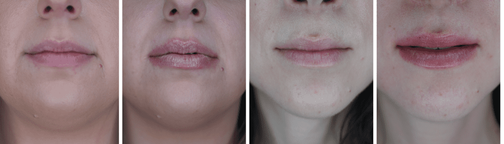 Before & After: Laser Lip Remodelling