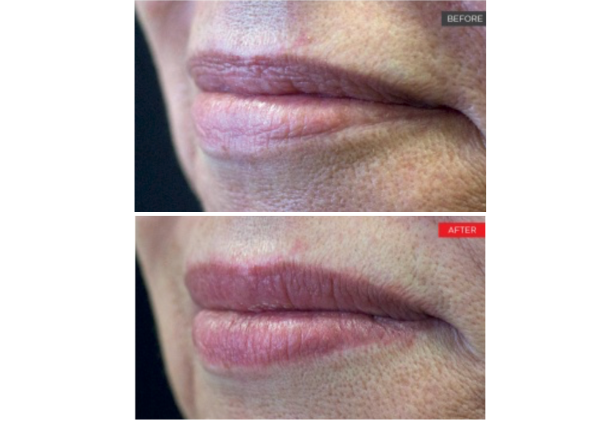 Laser Lip Remodelling