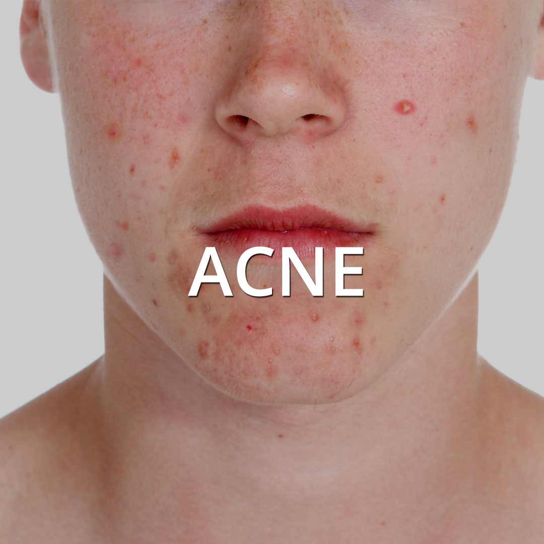 Acne