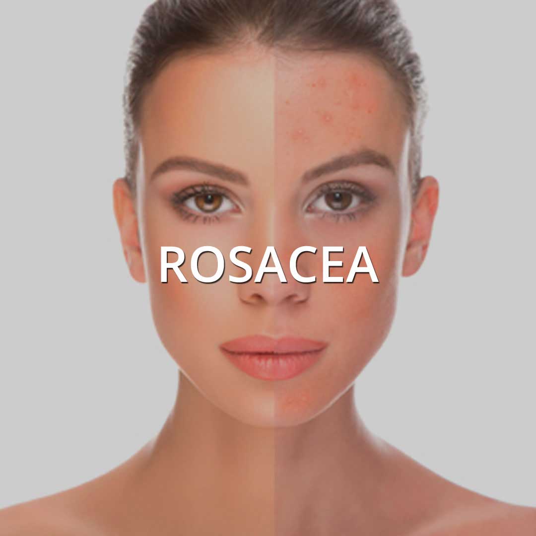 Rosacea