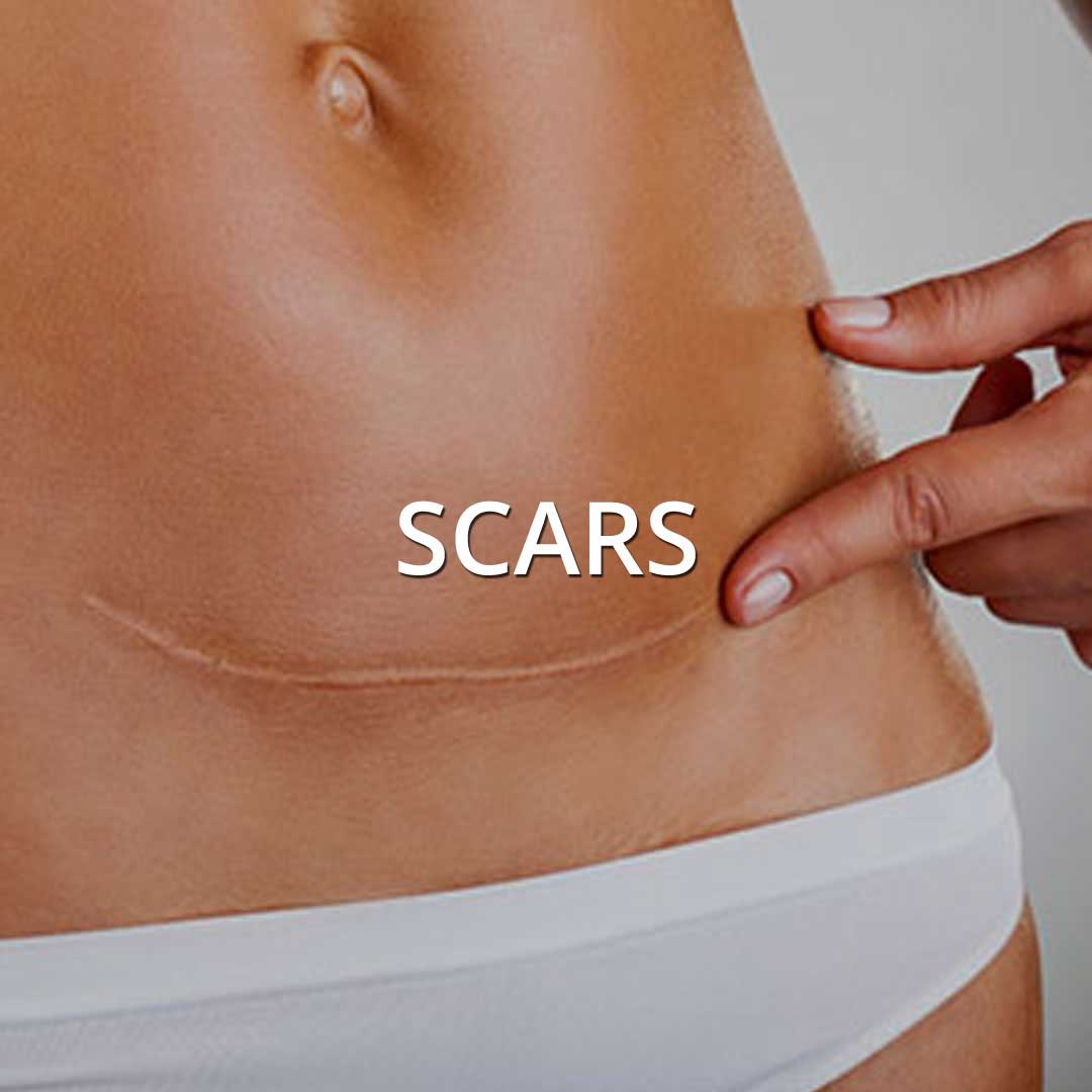 Scars